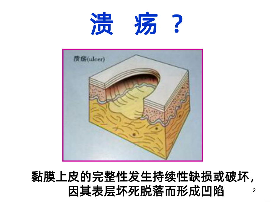 口腔黏膜溃疡类疾病PPT课件.ppt_第2页