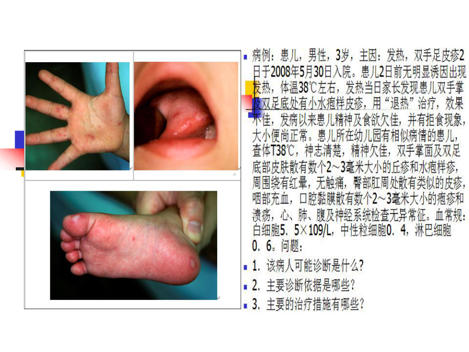 手足口病-PPT课件.ppt_第1页