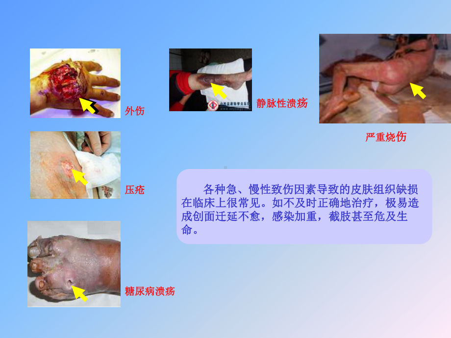 组织工程皮肤的研发 课件.ppt_第2页