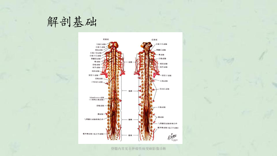 脊髓内常见非肿瘤性病变MR影像诊断课件.pptx_第3页