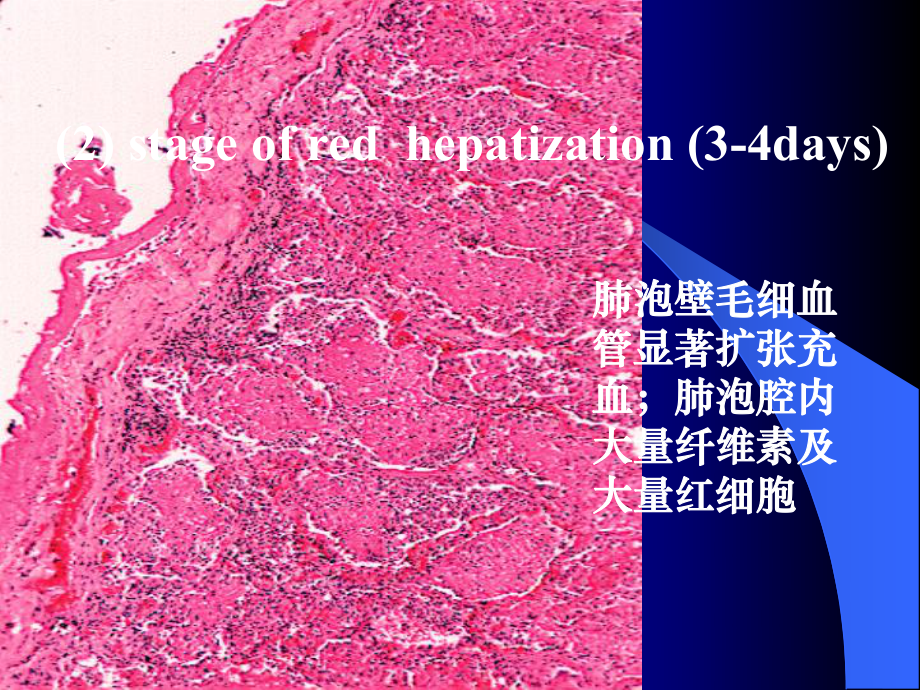 第七章-呼吸系统疾病(七年制)课件.ppt_第2页