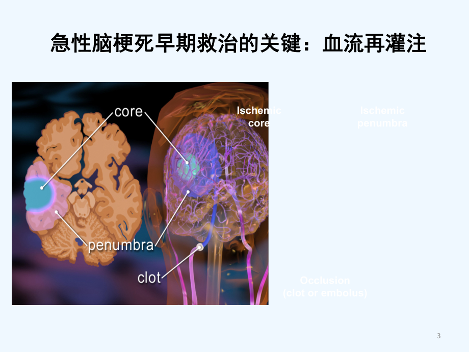 急性脑梗死静脉溶栓指南解读神经内科课件.ppt_第3页