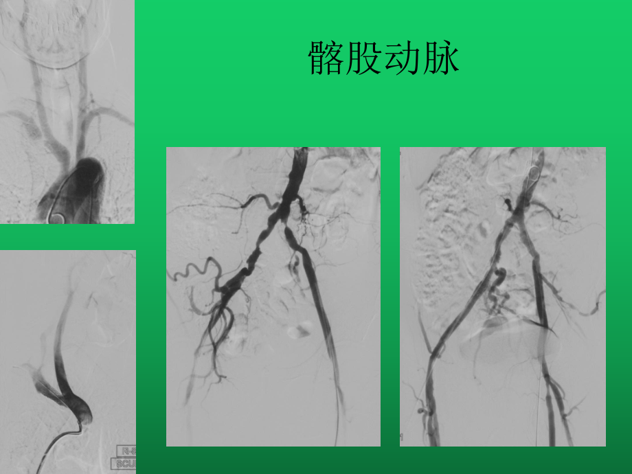 神经介入血管通路建立—导引导管的使用课件.pptx_第3页