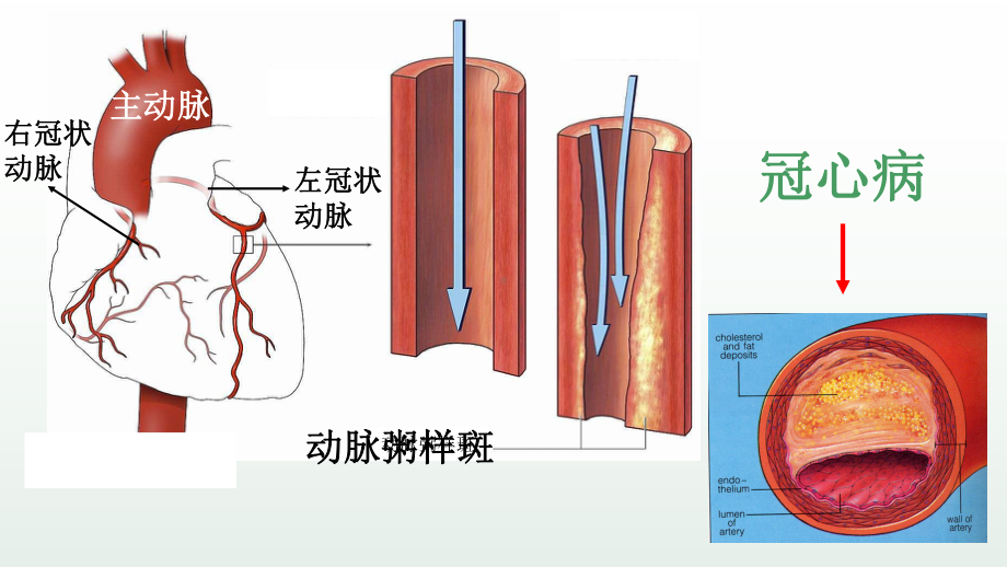 《冠心病》优课一等奖课件.pptx_第2页