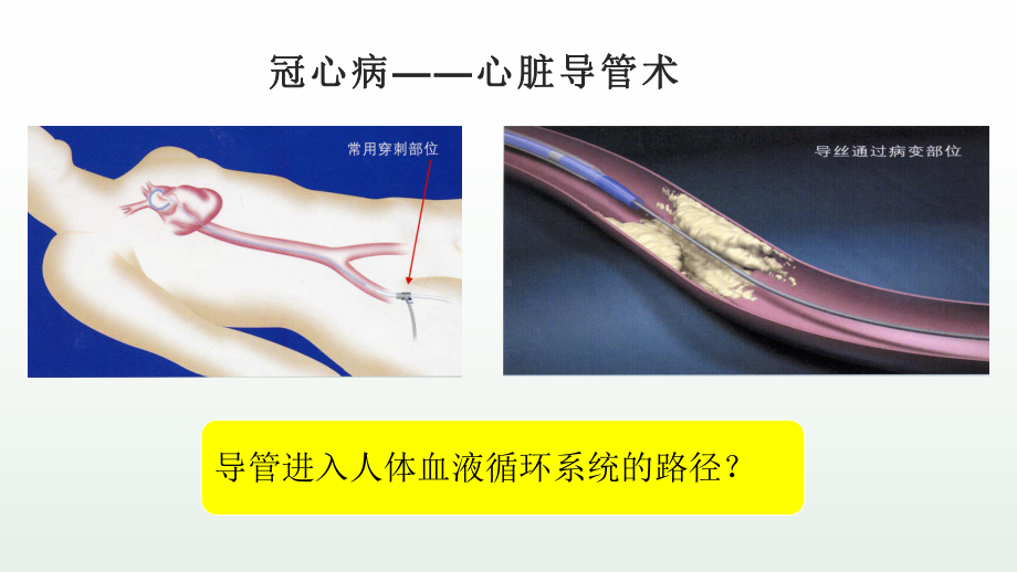 《冠心病》优课一等奖课件.pptx_第3页