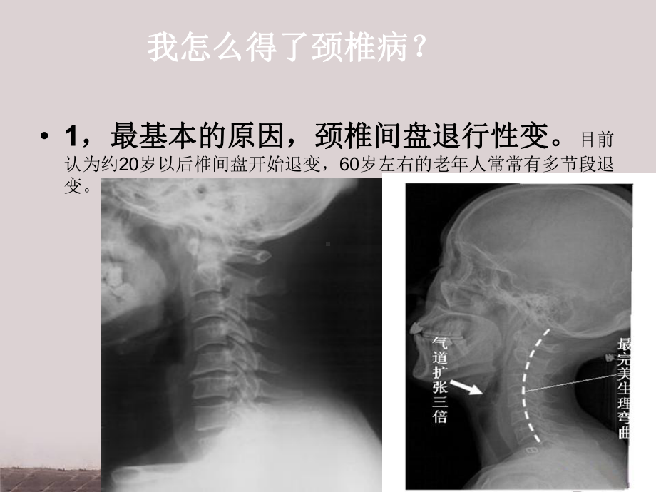 颈椎病的中医治疗方法-ppt课件.ppt_第3页