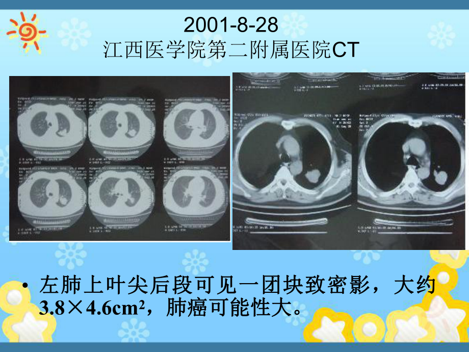 中医治疗肿瘤新策略-以肺癌为例课件.ppt_第3页