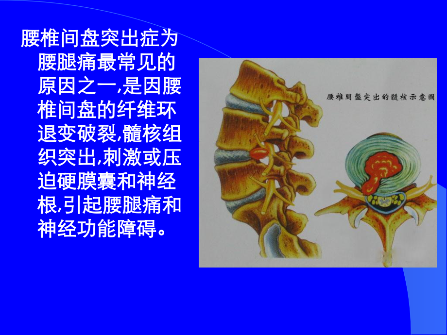 腰椎间盘突出症中医治疗PPT课件.ppt_第3页