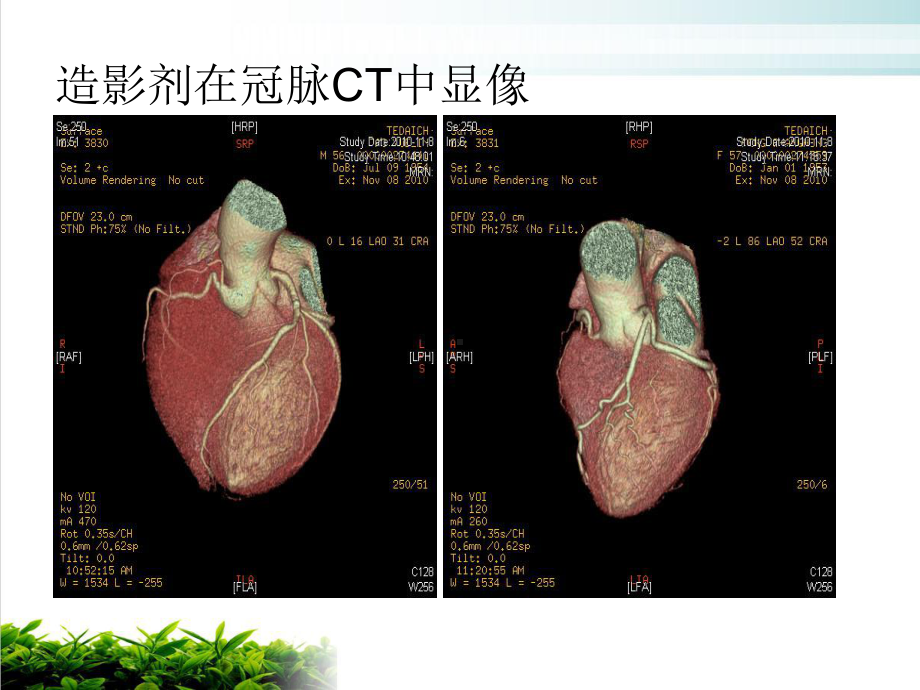 造影剂肾病完美版实用PPT课件.pptx_第1页