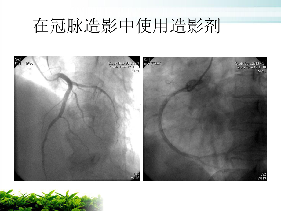 造影剂肾病完美版实用PPT课件.pptx_第2页