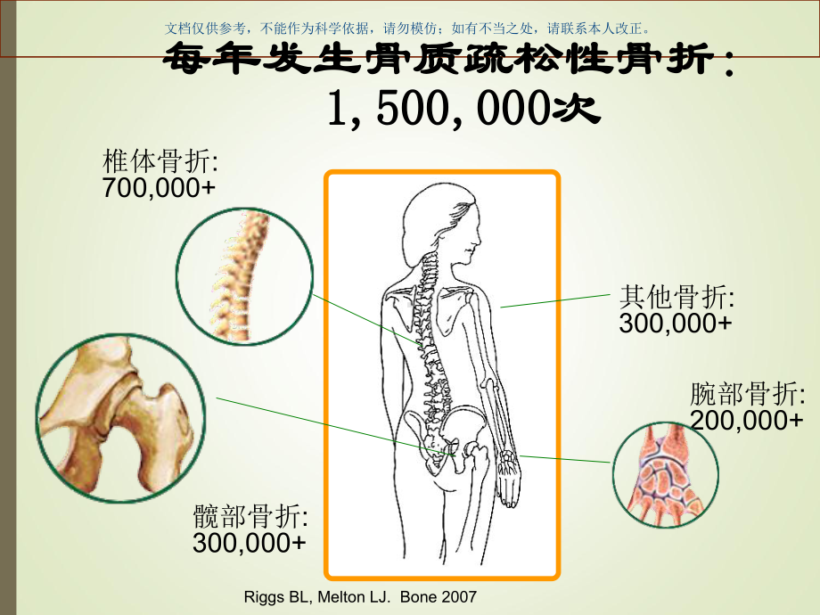 骨质疏松的现状课件.ppt_第2页