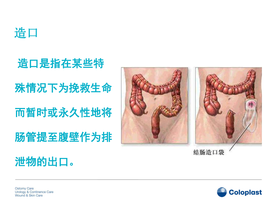 造口相关知识PPT课件PPT培训课件.ppt_第2页