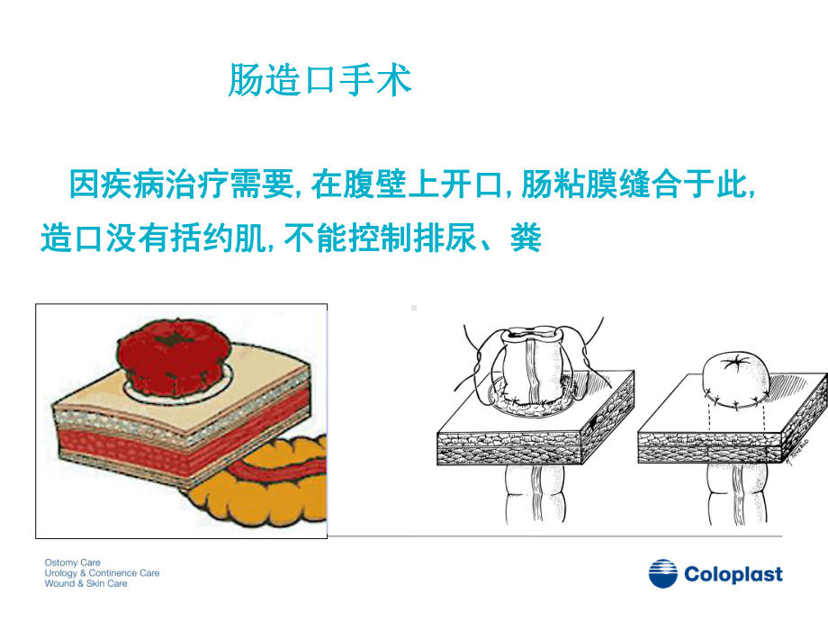 造口相关知识PPT课件PPT培训课件.ppt_第3页