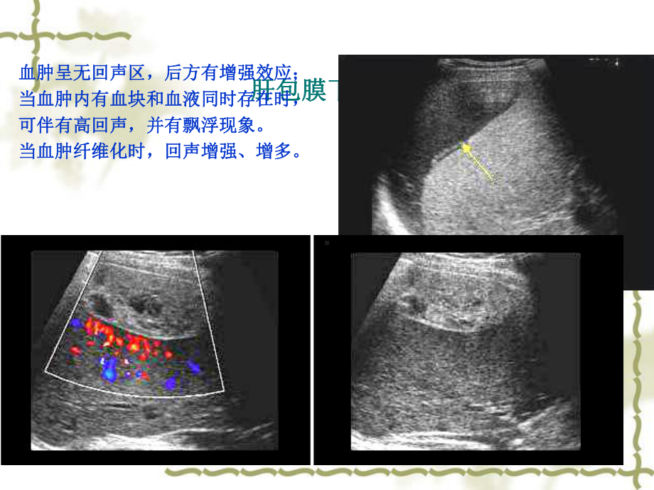 超声在急诊中的应用课件.ppt_第3页