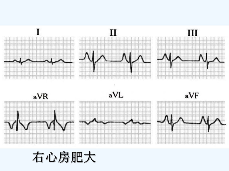 诊断学异常心电图[可修改版ppt]课件.ppt_第3页