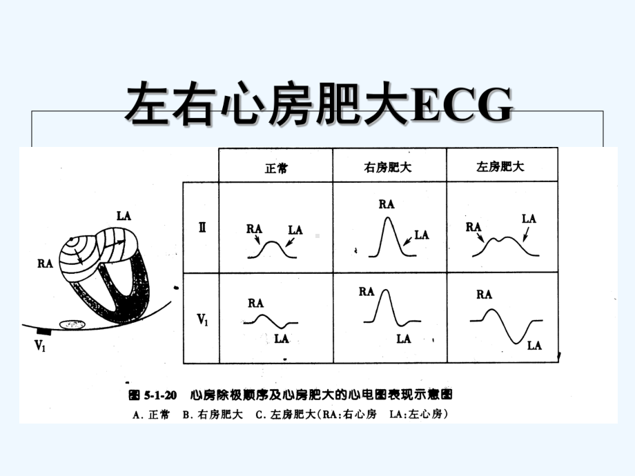 左心房肥大的心电图图片