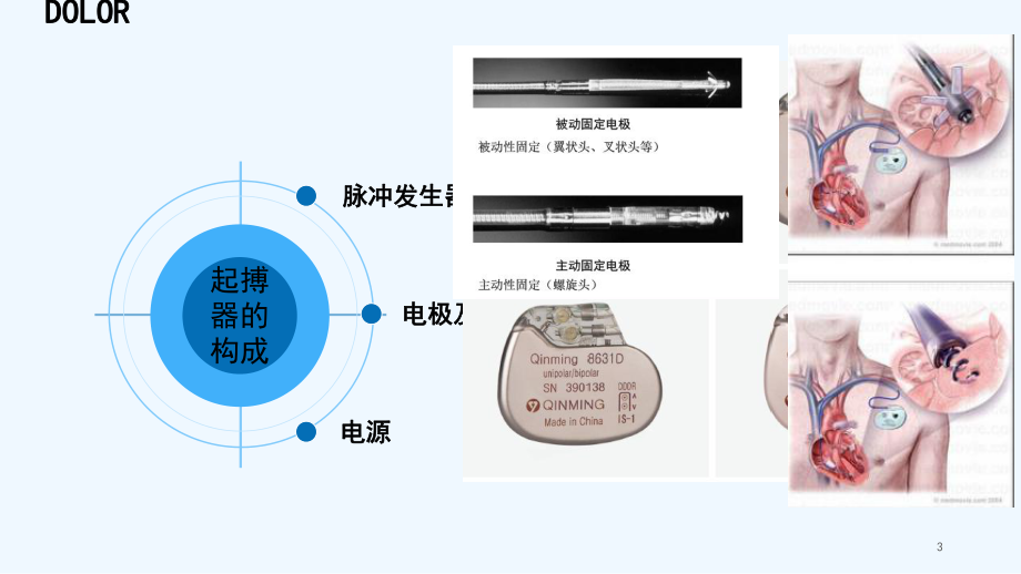 永久性心脏起搏器植入术后护理-PPT课件.ppt_第3页