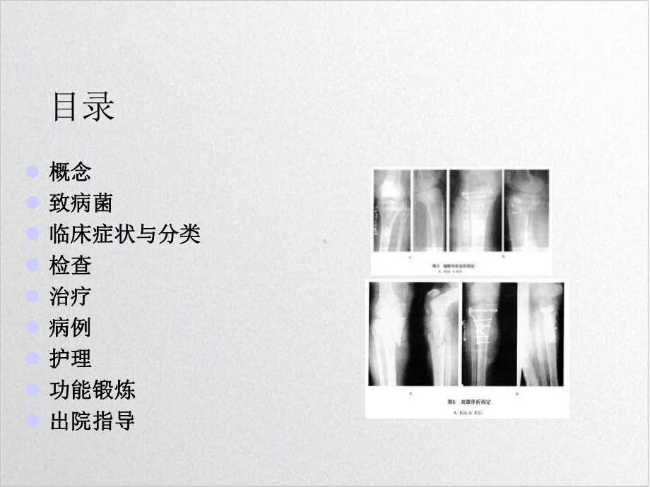 骨髓炎的护理查房课件PPT.ppt_第2页