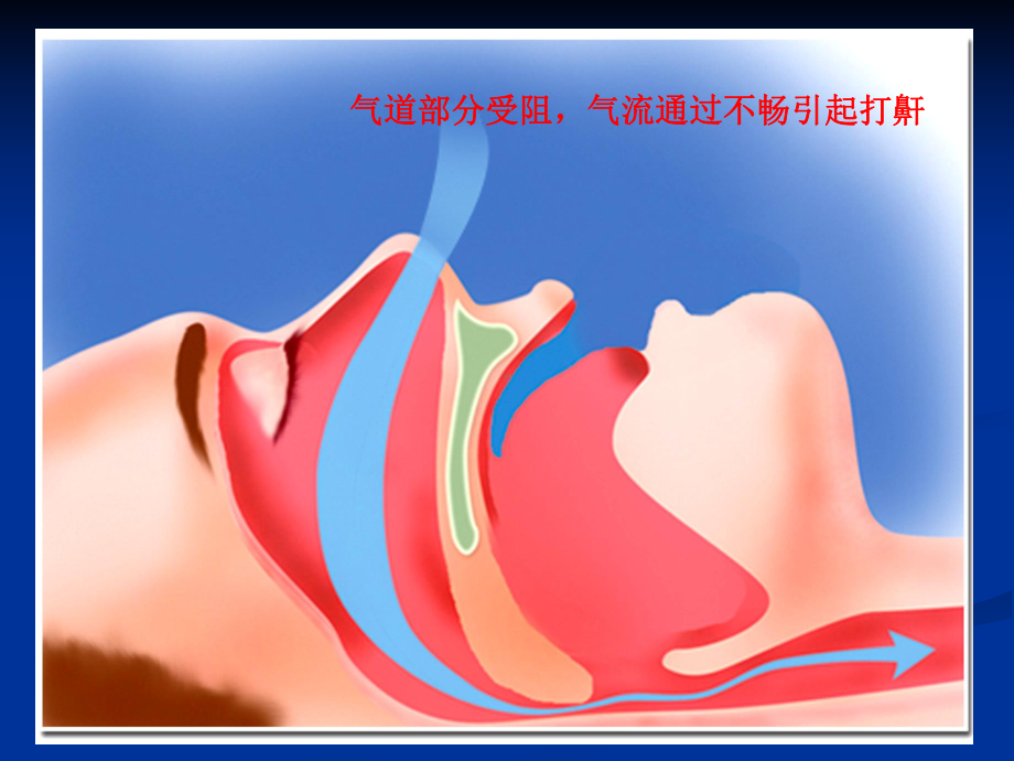 阻塞性睡眠呼吸暂停综合征的诊治课件.pptx_第3页