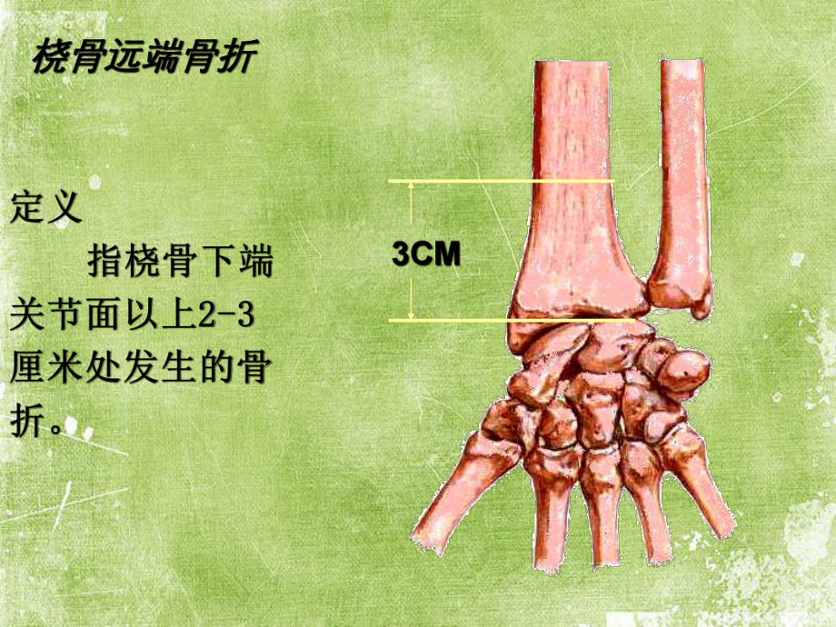 桡骨远端骨折课件ppt.ppt_第2页