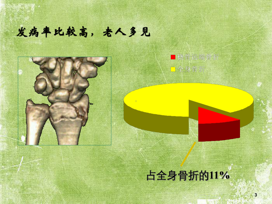 桡骨远端骨折课件ppt.ppt_第3页