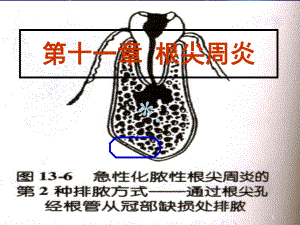 根尖周炎ppt课件《精品》.ppt.ppt