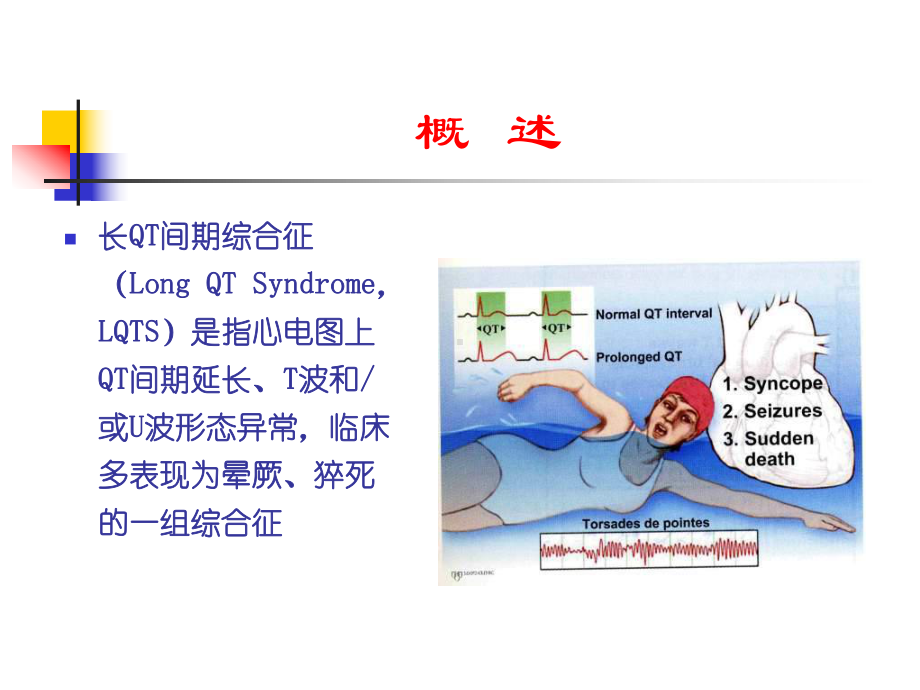 长QT综合征的心电图特征及诊治进展课件.ppt_第2页