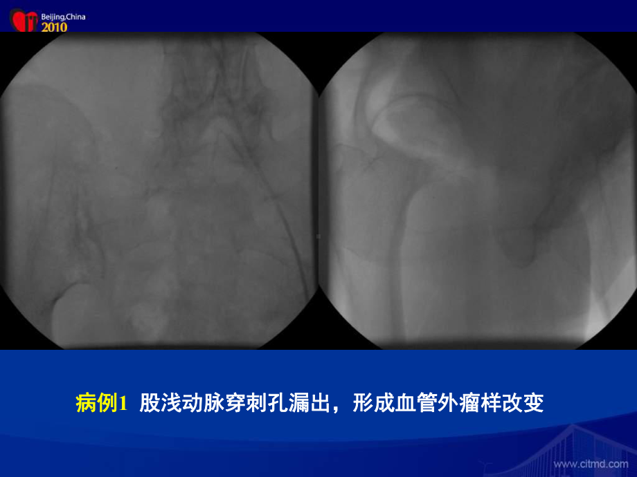 诊断和治疗穿刺部位并发症课件.pptx_第3页