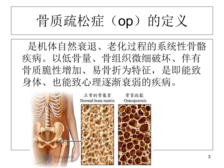 骨质疏松症的护理-ppt课件.ppt_第3页