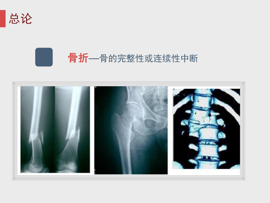 骨折的固定及搬运-医学课件.ppt_第2页