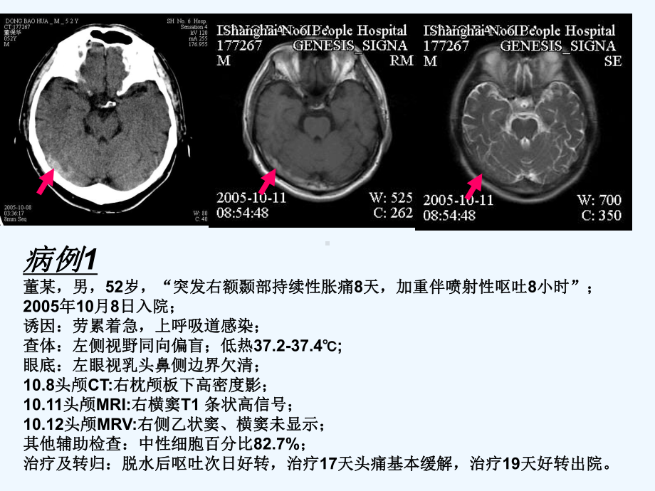 脑静脉系统血栓形成[可修改版ppt]课件.ppt_第2页