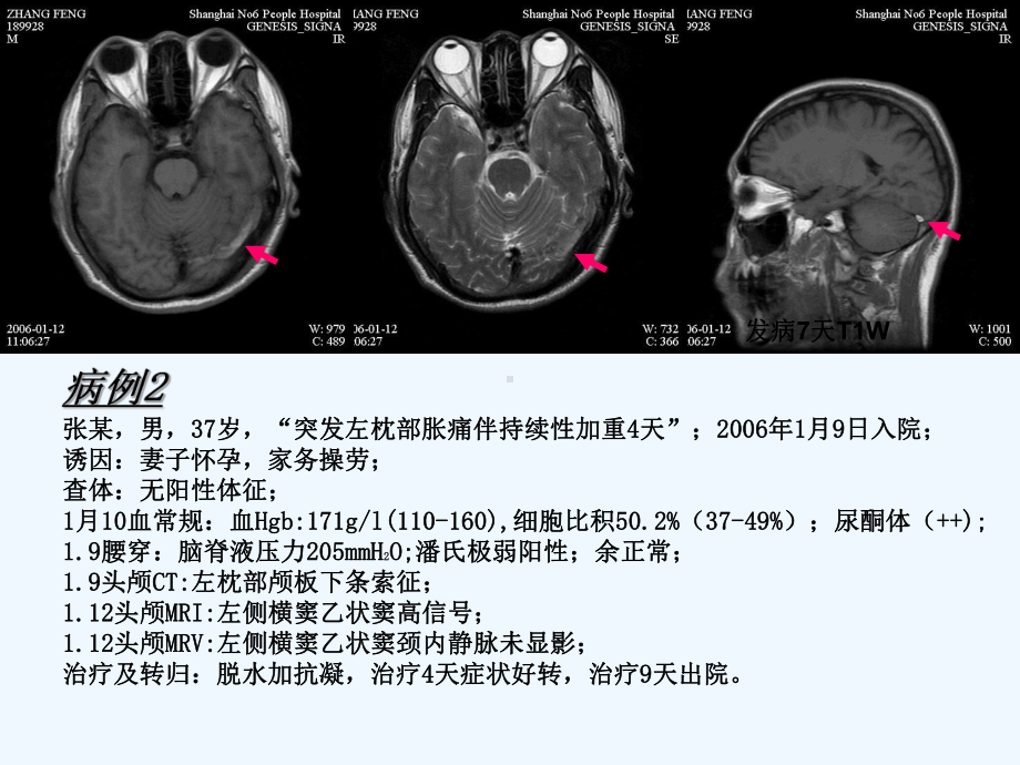 脑静脉系统血栓形成[可修改版ppt]课件.ppt_第3页