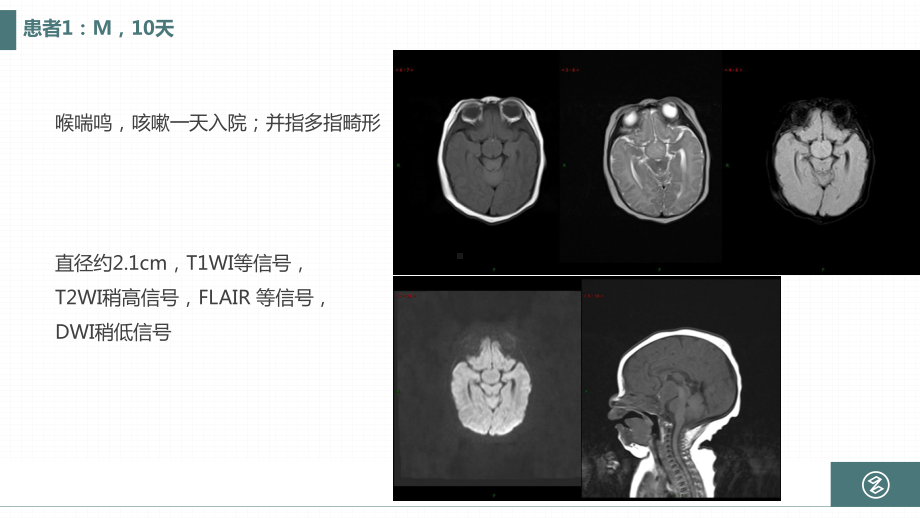 灰结节错构瘤课件.pptx_第3页