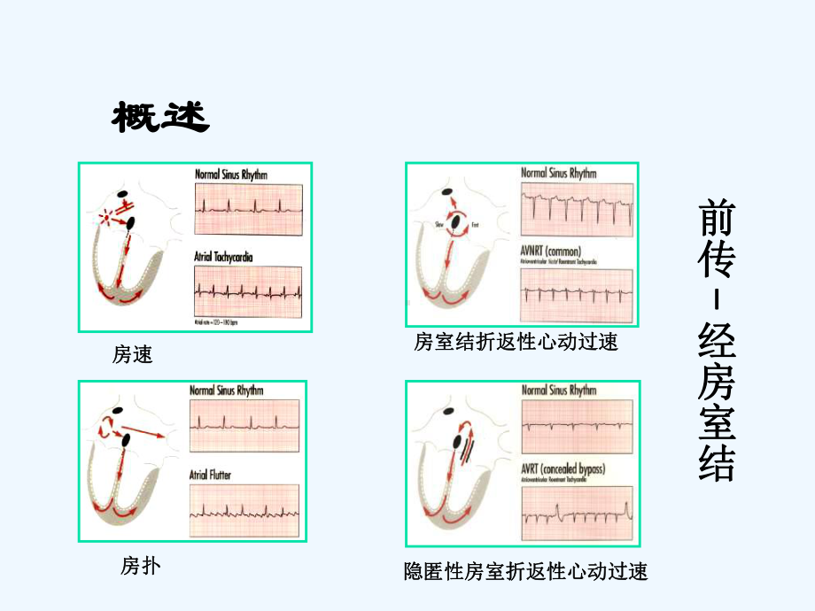 窄QRS波心动过速概述分类和鉴别诊断[可修改版ppt]课件.ppt_第2页