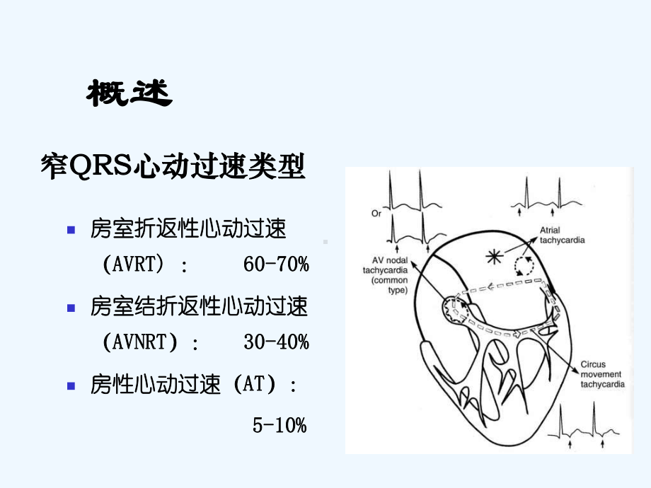 窄QRS波心动过速概述分类和鉴别诊断[可修改版ppt]课件.ppt_第3页