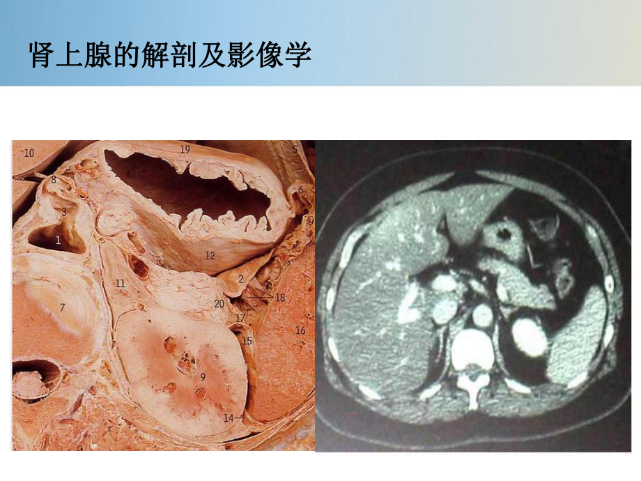 肾上腺皮质功能减退症.pptx_第3页