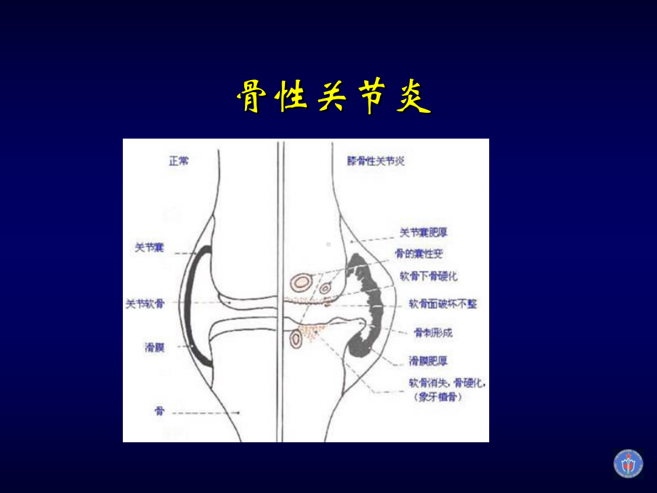 膝关节骨性关节炎的分级治疗课件.pptx_第3页