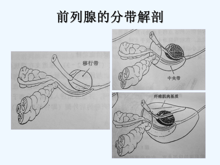 磁共振-前列腺癌-诊断标准[可修改版ppt]课件.ppt_第3页