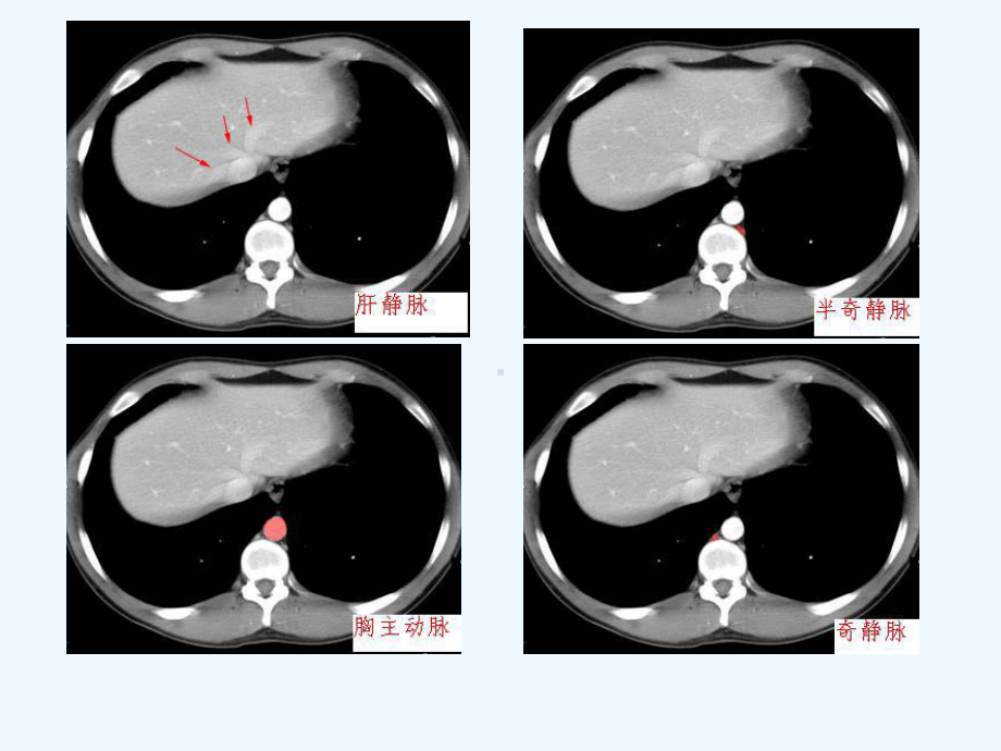 腹部CT诊断(很经典)[可修改版ppt]课件.ppt_第3页