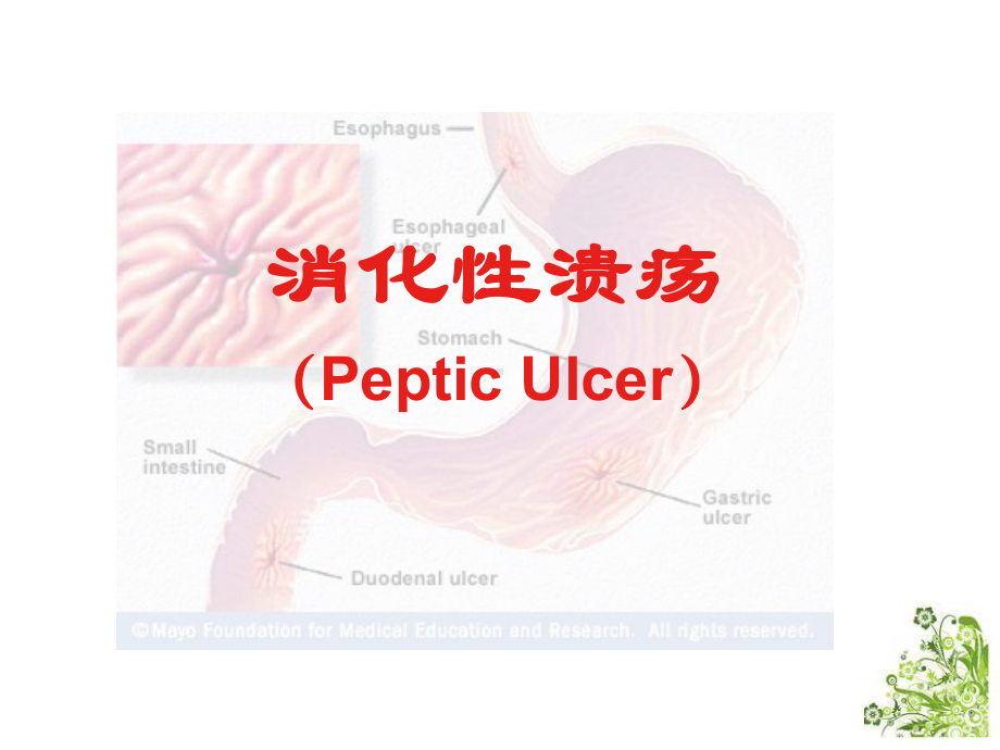 消化性溃疡本科课件.ppt_第1页