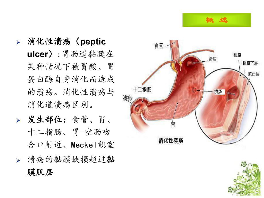 消化性溃疡本科课件.ppt_第2页