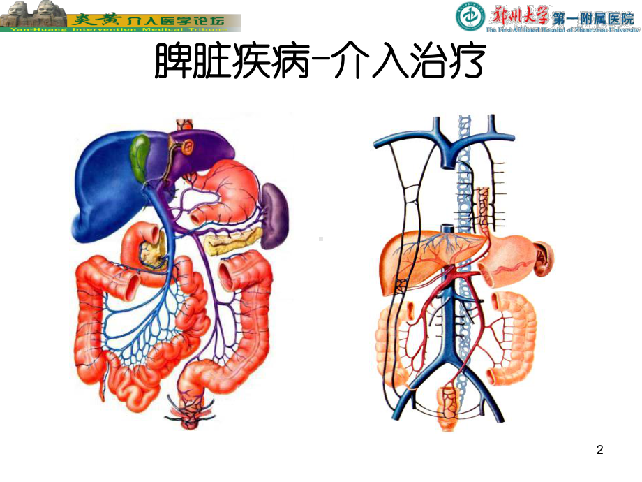 脾脏的介入栓塞治疗PPT培训课件.ppt_第2页