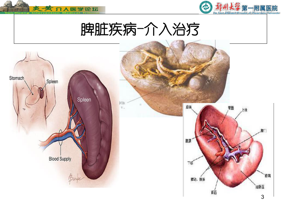 脾脏的介入栓塞治疗PPT培训课件.ppt_第3页