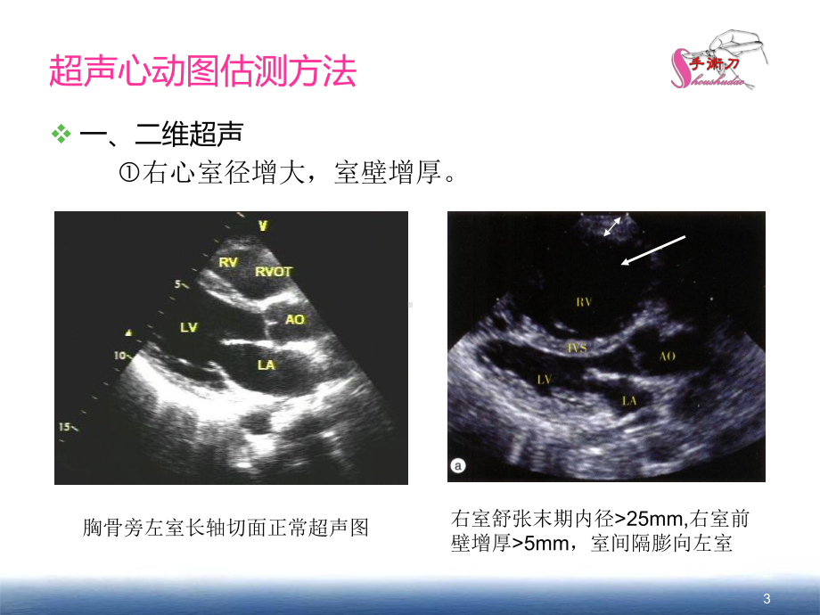 肺动脉高压的超声诊断课件.ppt_第3页