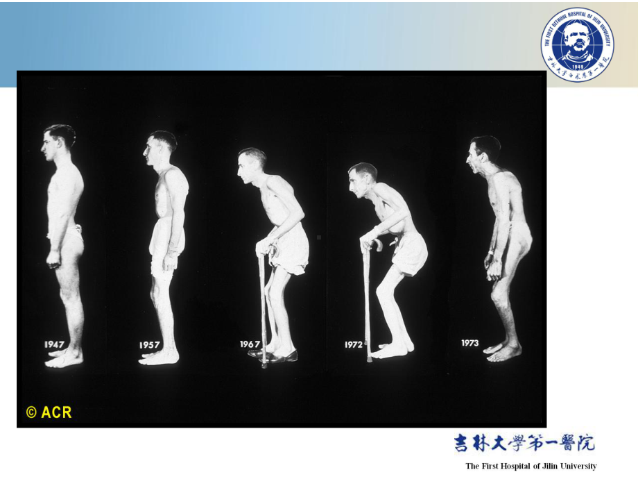 强直性脊柱炎.ppt_第3页