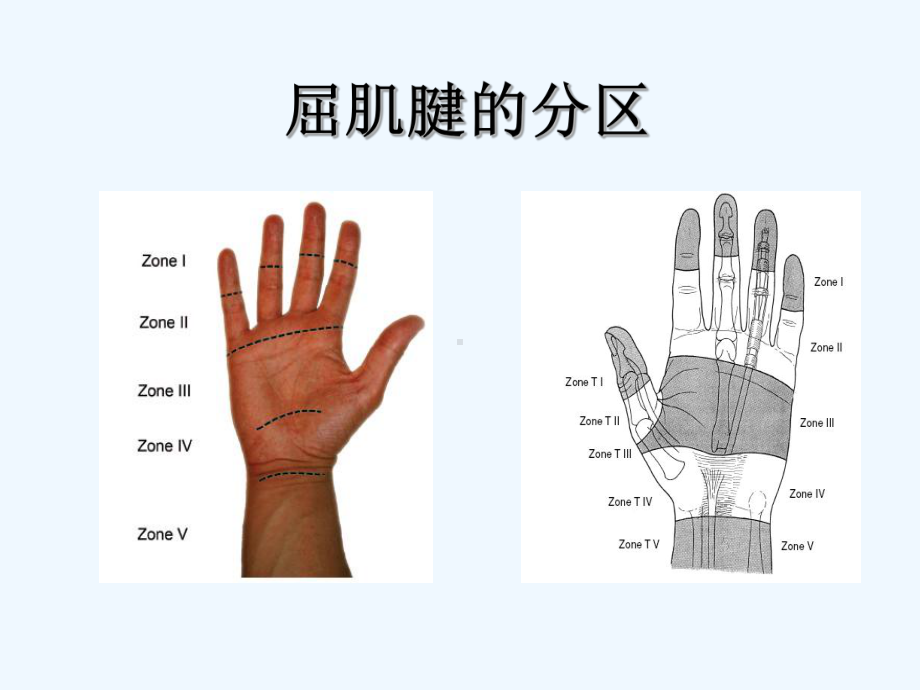 精选手部肌腱损伤讲义(ppt)课件.ppt_第3页