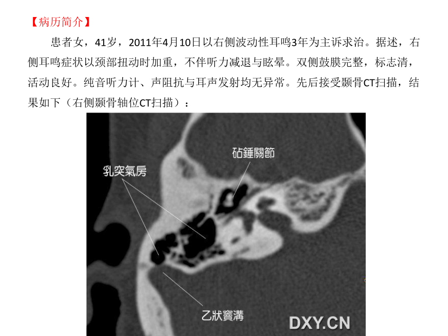 耳鸣和乙状窦憩室讲义课件.ppt_第2页