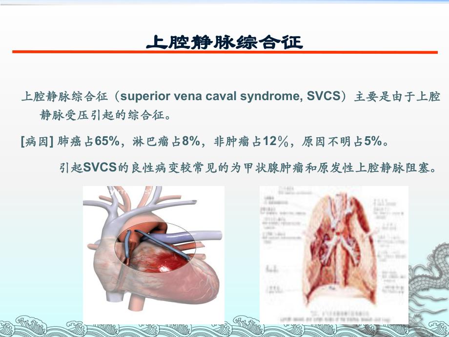 肿瘤内科常见急症的诊断与护理课件.ppt_第3页