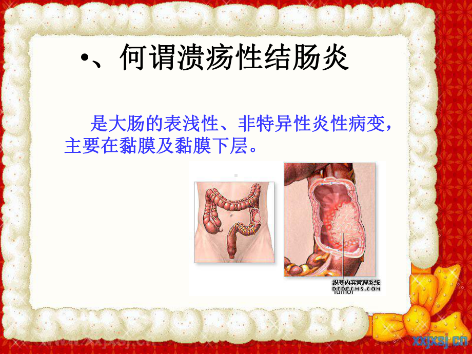 溃疡性结肠炎健康指导PPT课件.ppt_第2页