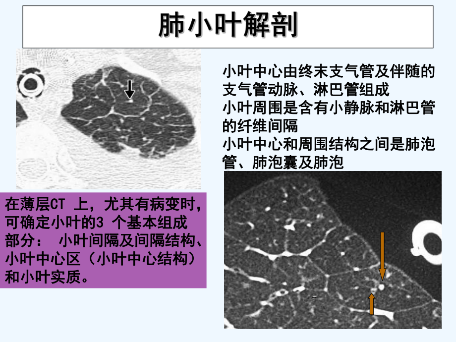 肺间质纤维化的影像表现[可修改版ppt]课件.ppt_第3页